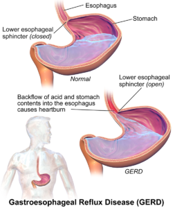 GERD and back pain - gerd