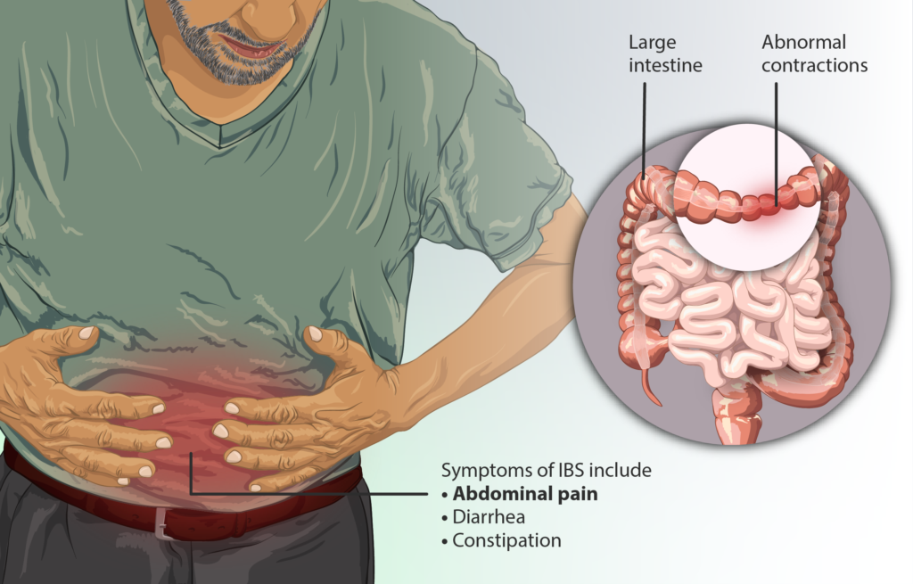 Irritable Bowel Syndrome